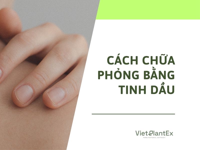 Cách chữa bị phỏng